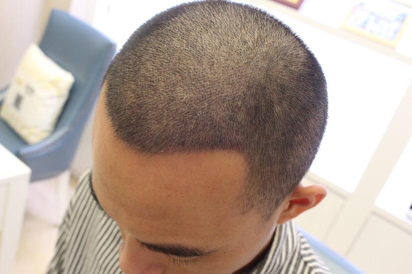 植发一颗发多少钱(植发大约多少钱一根)