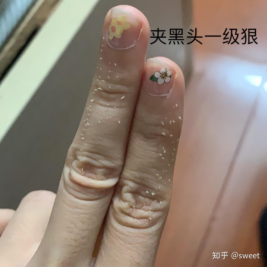 挤黑头有多爽?