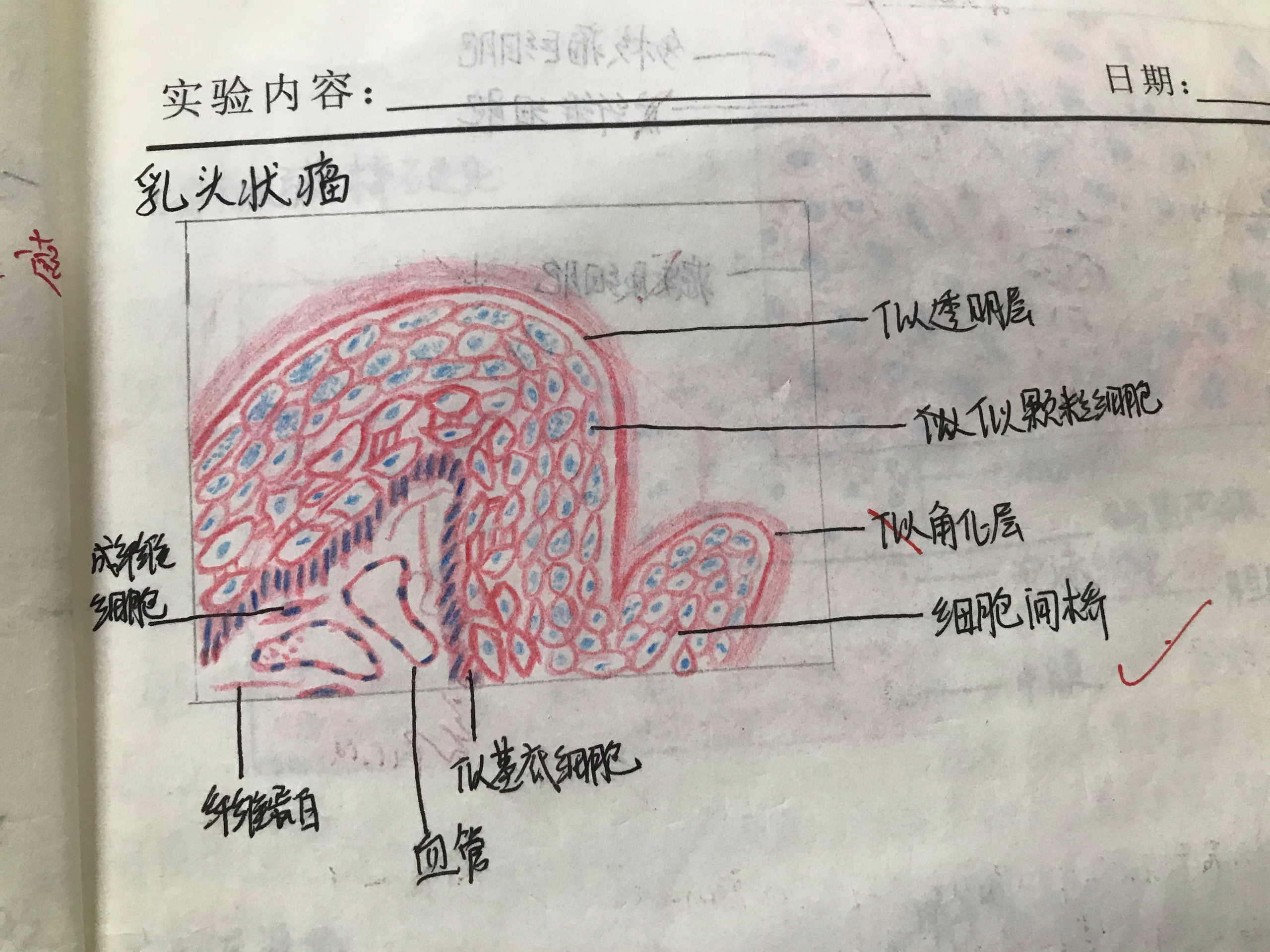 高血压肾病14风湿性心肌炎(同样要标注特征细胞,就是我错的那个)15