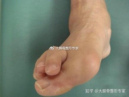 大脚骨拇指外翻的畸变原因及矫正方法