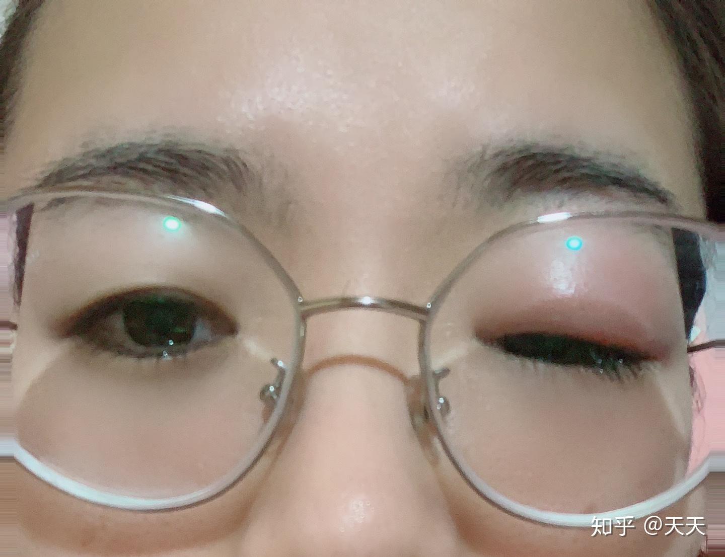 上眼皮麦粒肿了还挺大出现了脓头该怎么办啊求大神们分享