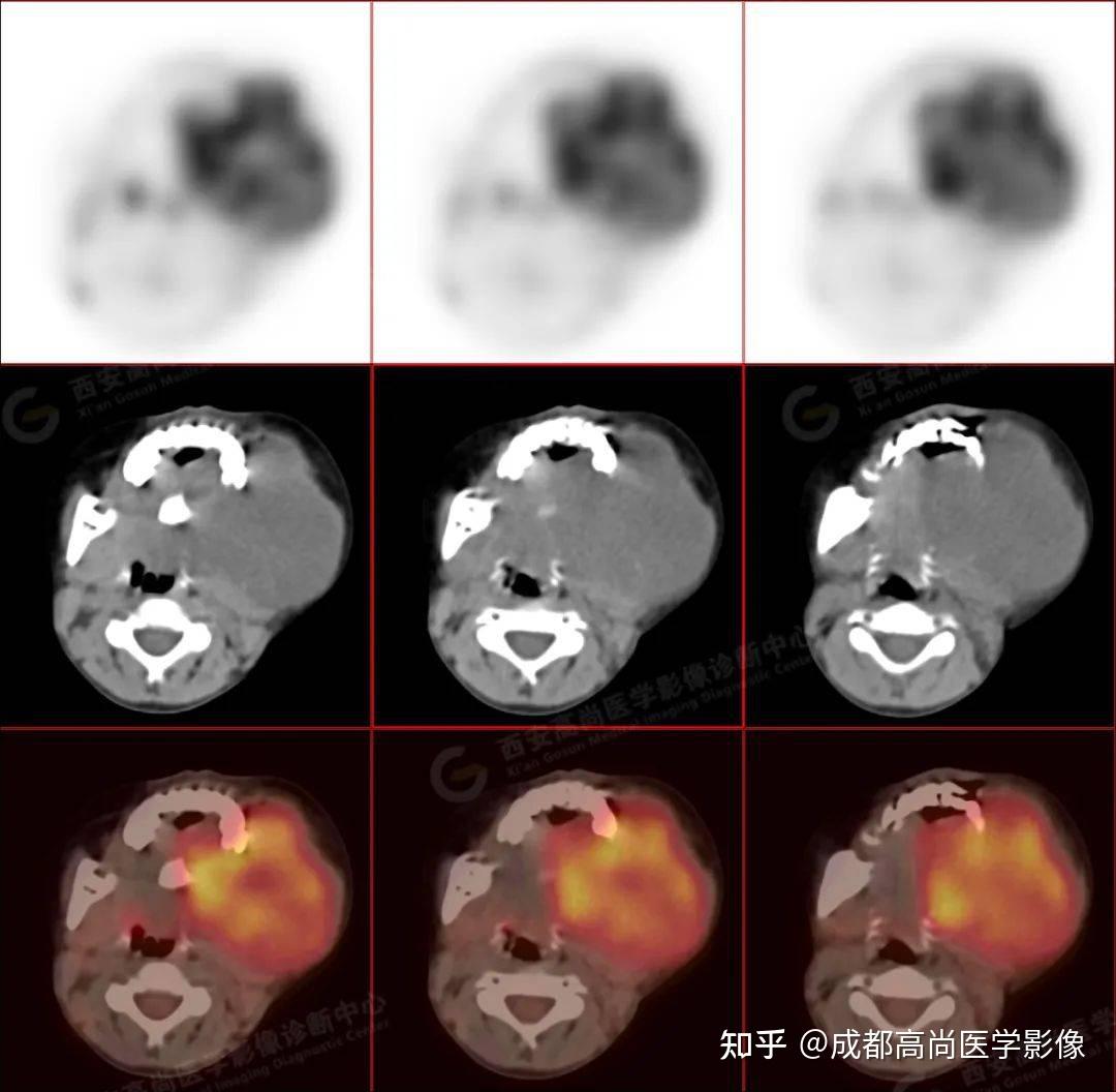 【高尚病例】PET/CT病例-儿童颌面部横纹肌肉瘤1例 - 知乎