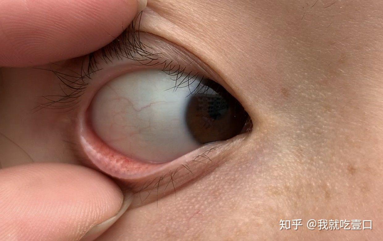 结膜血管明显怎么办?
