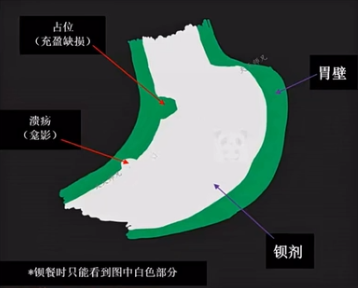 【医学笔记】医学影像-龛影与充盈缺损