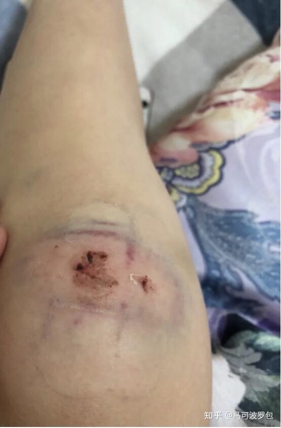 大腿上的冻疮疤痕怎么去除好