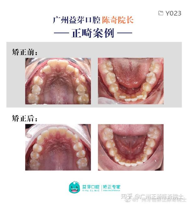 小朋友牙弓狭窄应该怎么办呢