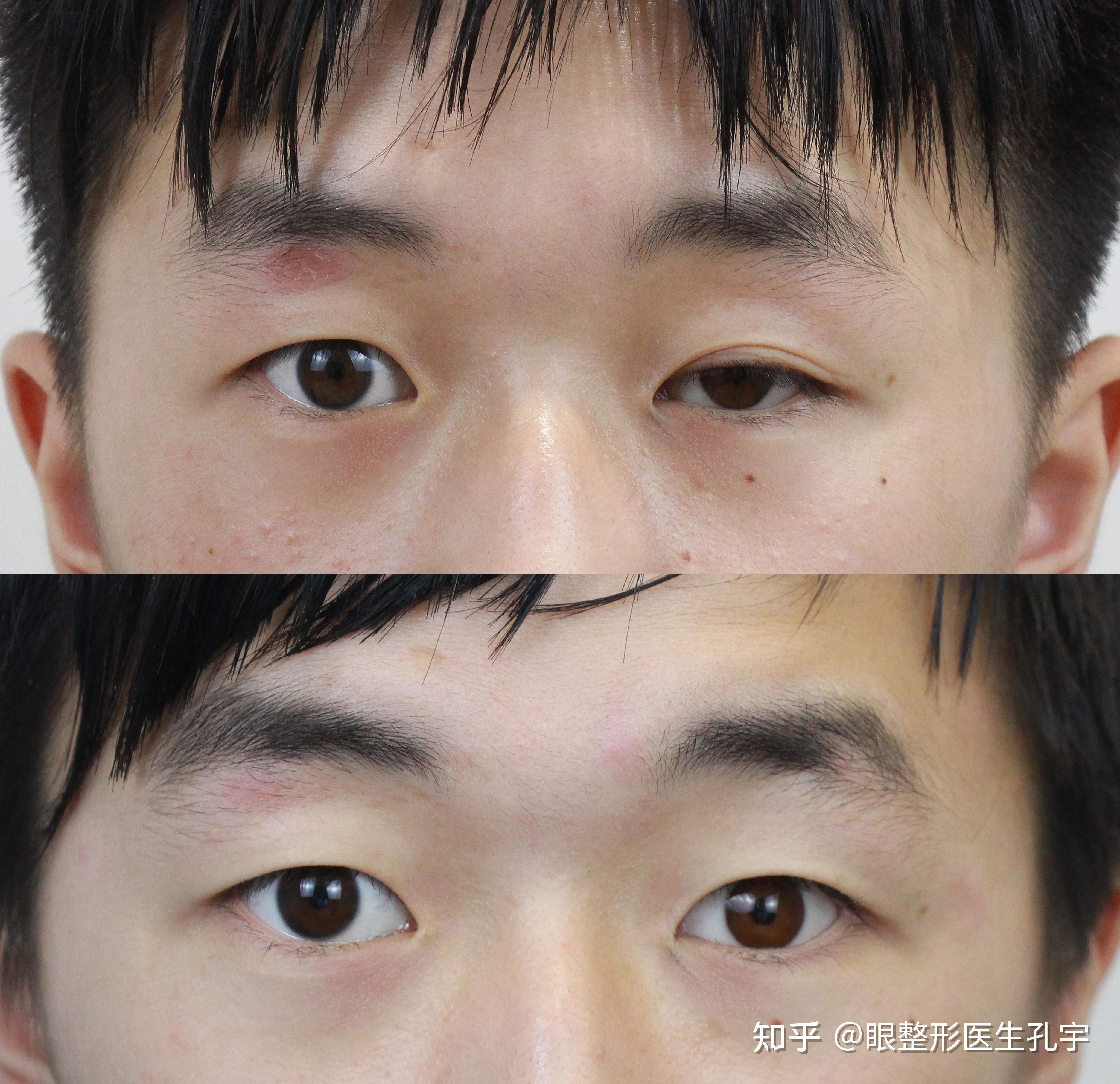 义眼 带久了 有左边眼睛下垂的现象 双眼皮也不对称 怎么办?