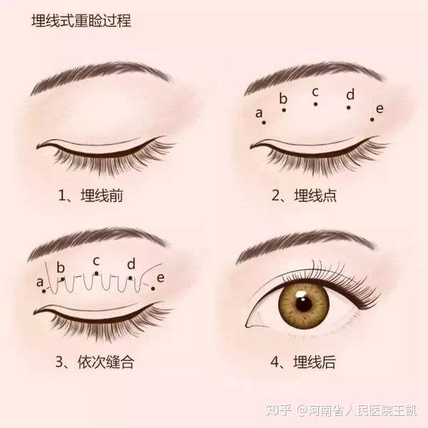 怎么才能有双眼皮学生党 v2-51614a29fffef08ef8ed5d24299f5ba8_r.jpg