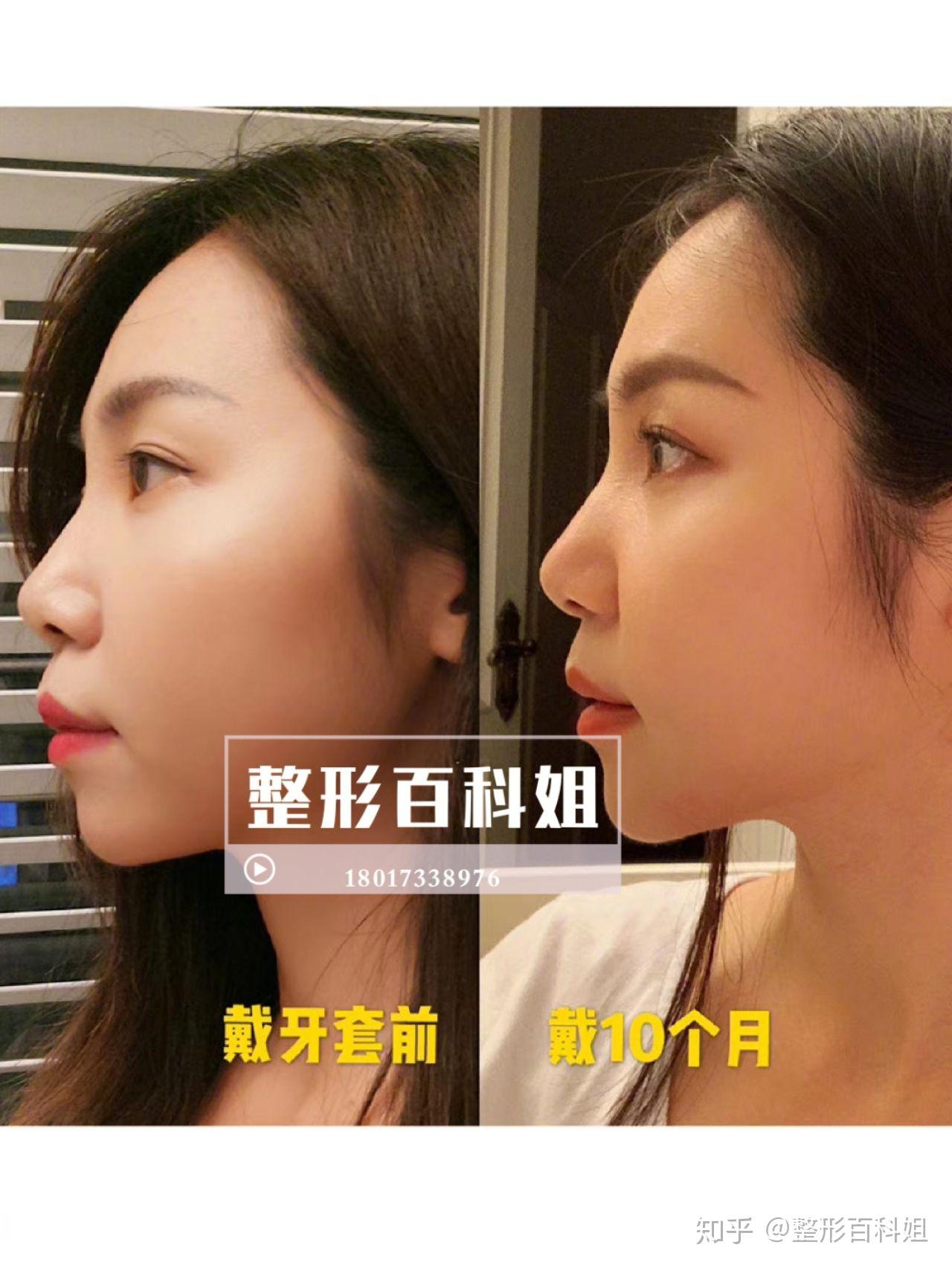 凸嘴下巴后缩牙齿矫正能改善吗