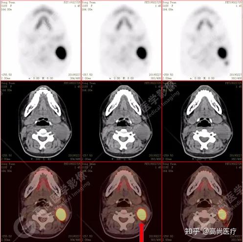 警惕青少年发现单侧听力下降脖子肿大鼻咽癌