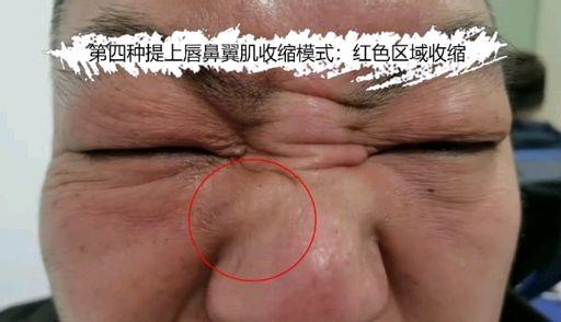 提上唇鼻翼肌的不同收缩模式 - 知乎