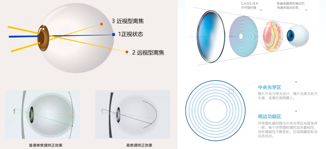 离焦镜片的前世今生丨青少年近视,看这篇就够了 - 知乎