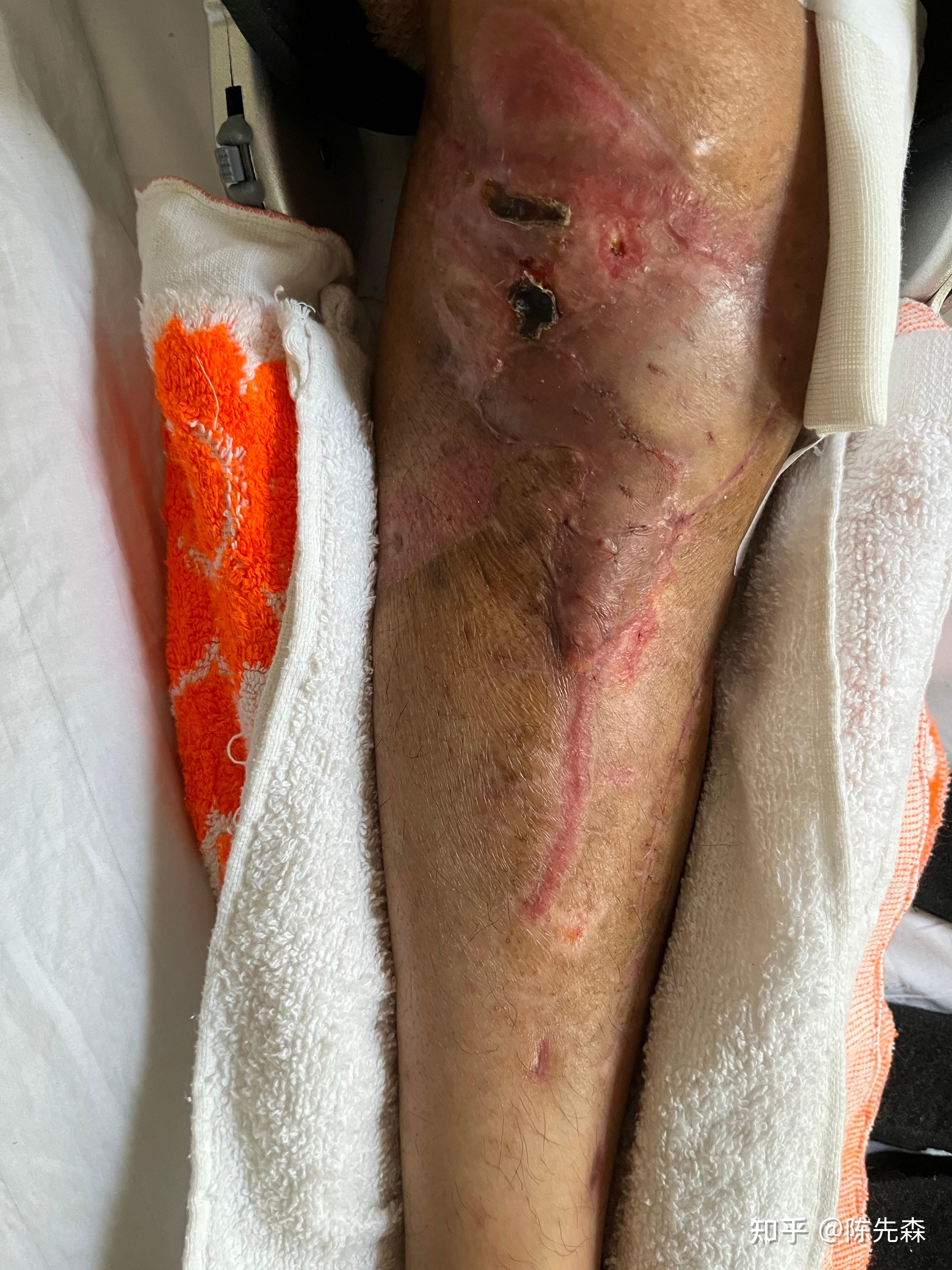 记录自己胫骨平台开放性骨折并且严重骨缺损的治疗经历