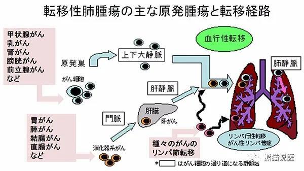 生命新希望 日本质子治疗转移性肺癌效果显著 知乎