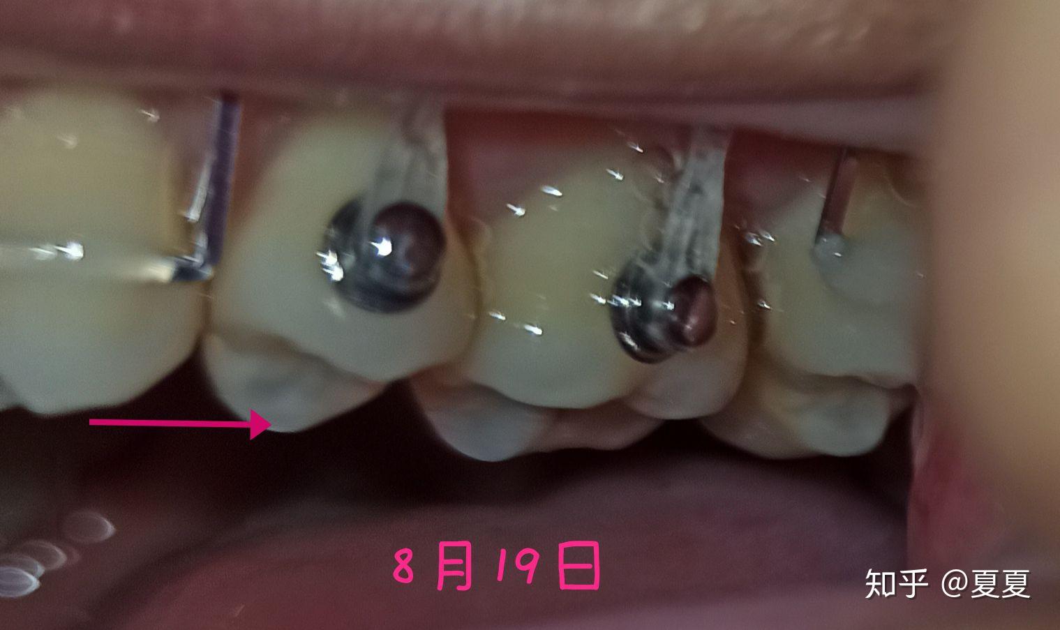 对颌牙伸长怎么办呐