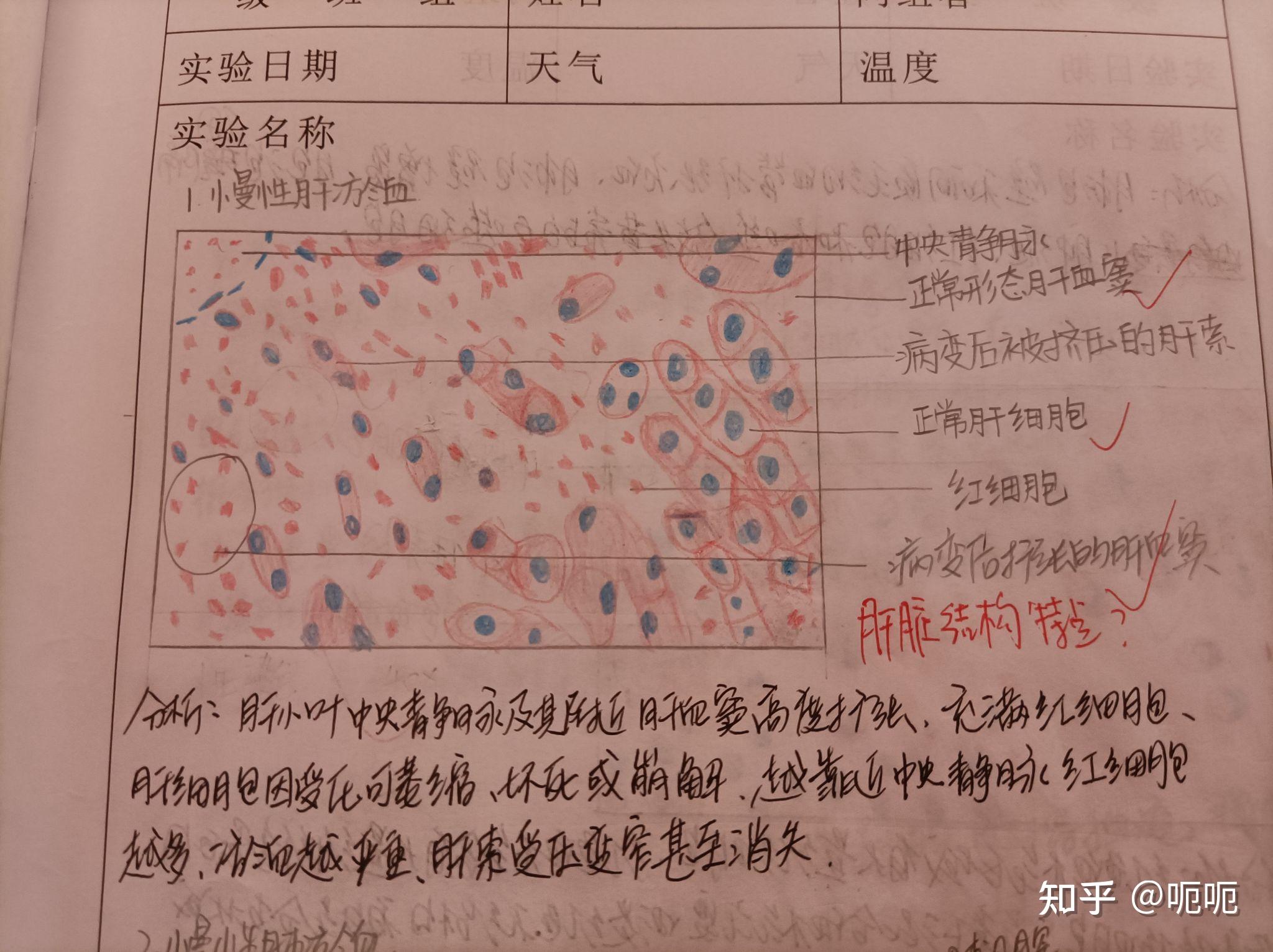 病理手绘铅笔画肝淤血肺淤血混合血栓