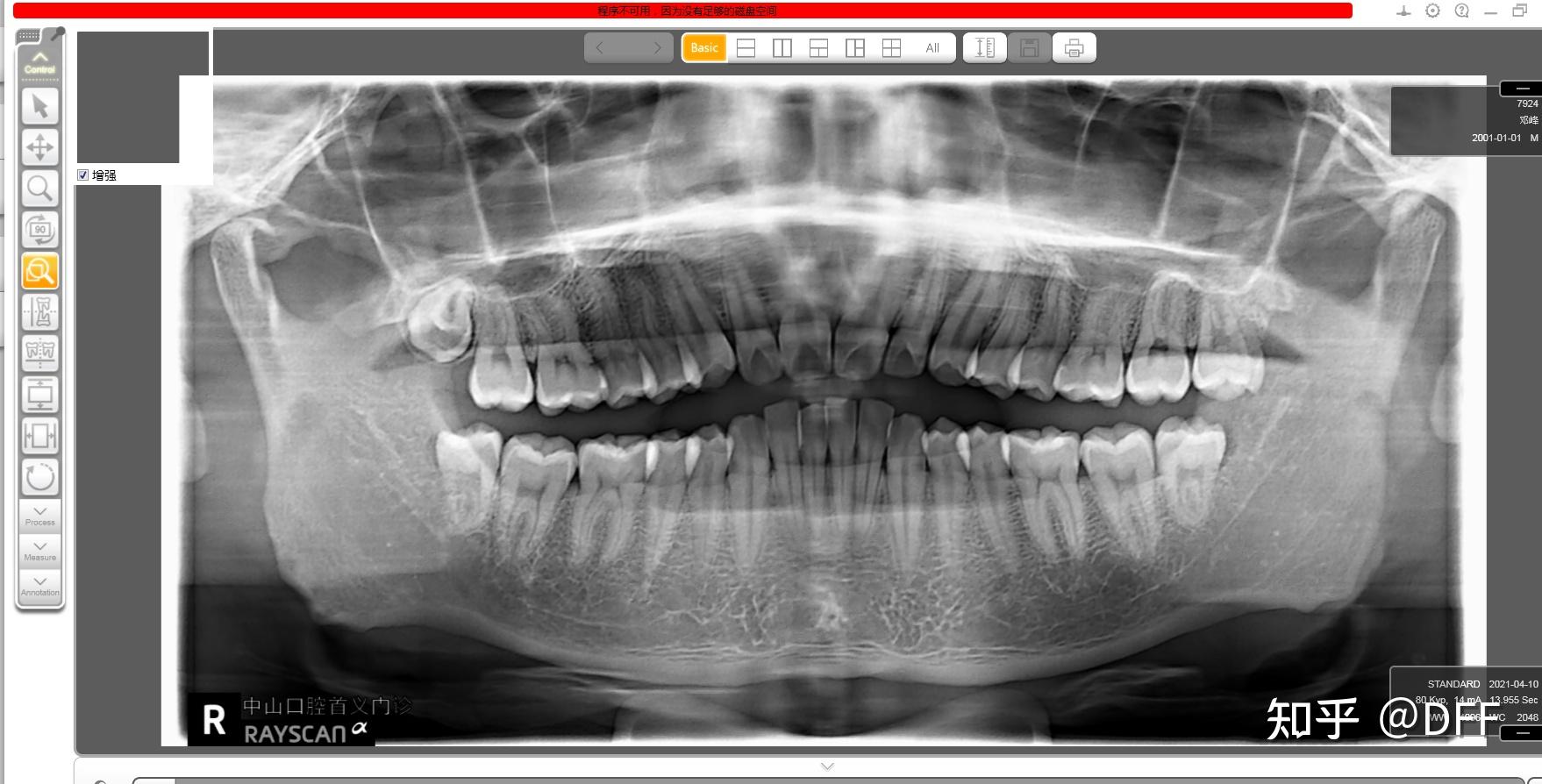 看看大家的牙片对一对自己的智齿位置