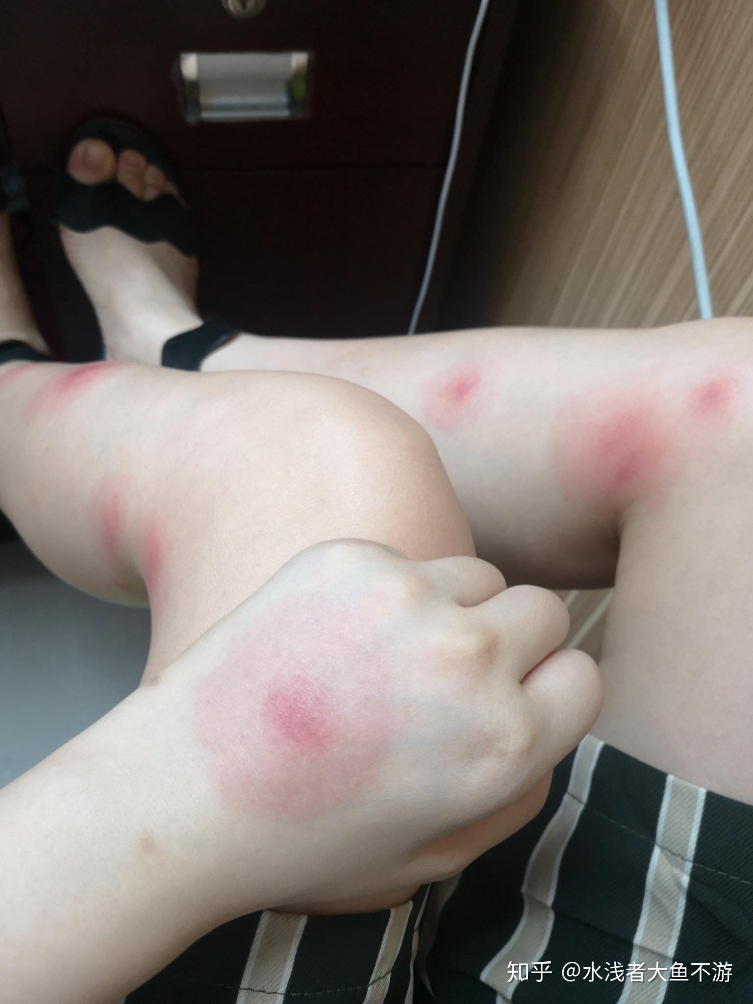 被蚊子咬的包第二天都肿的特别大怎办