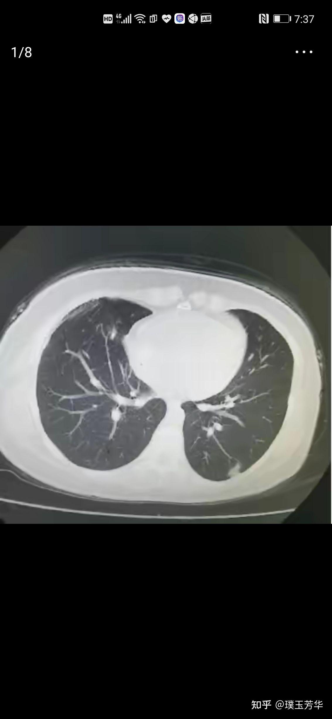 拍了肺部x片,却发现左下肺叶下方一点阴影，要不要紧啊？_百度知道