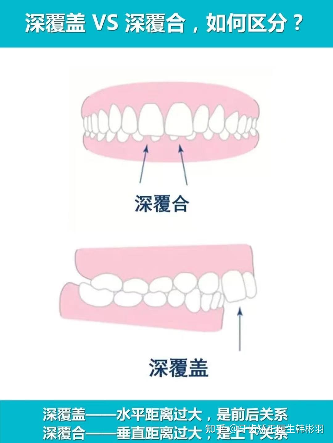 这样算深覆盖或者深覆合嘛?