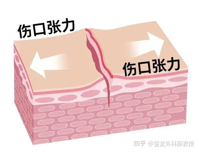 普通缝合和美容缝合有什么区别？ - 知乎