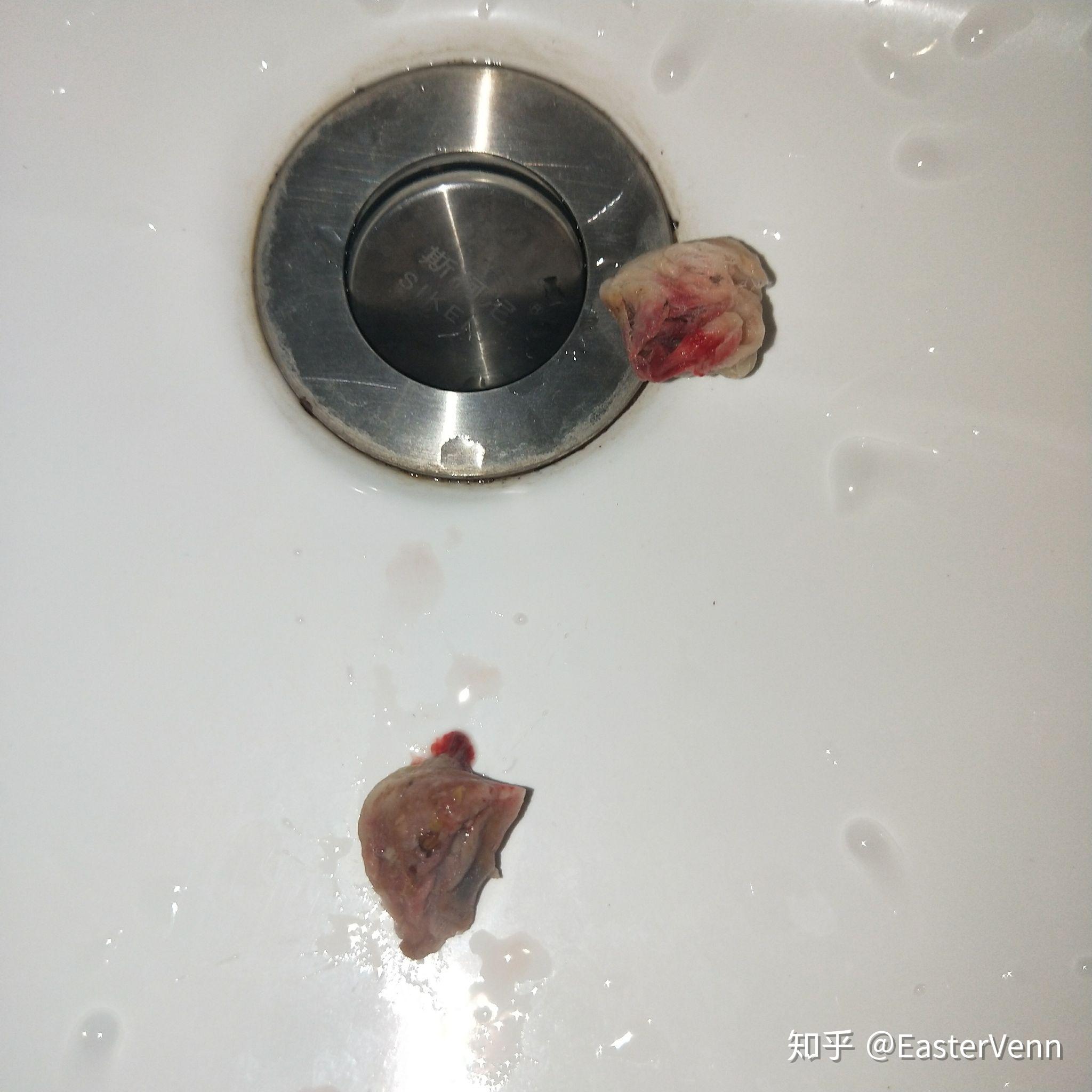 那些拔智齿以后忘记吐棉球或者少吐一个人都怎么样了