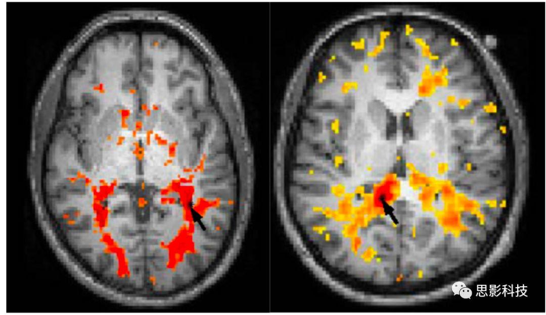 Magnetic Resonance Imaging:白质fMRI及静息态功能连接 - 知乎