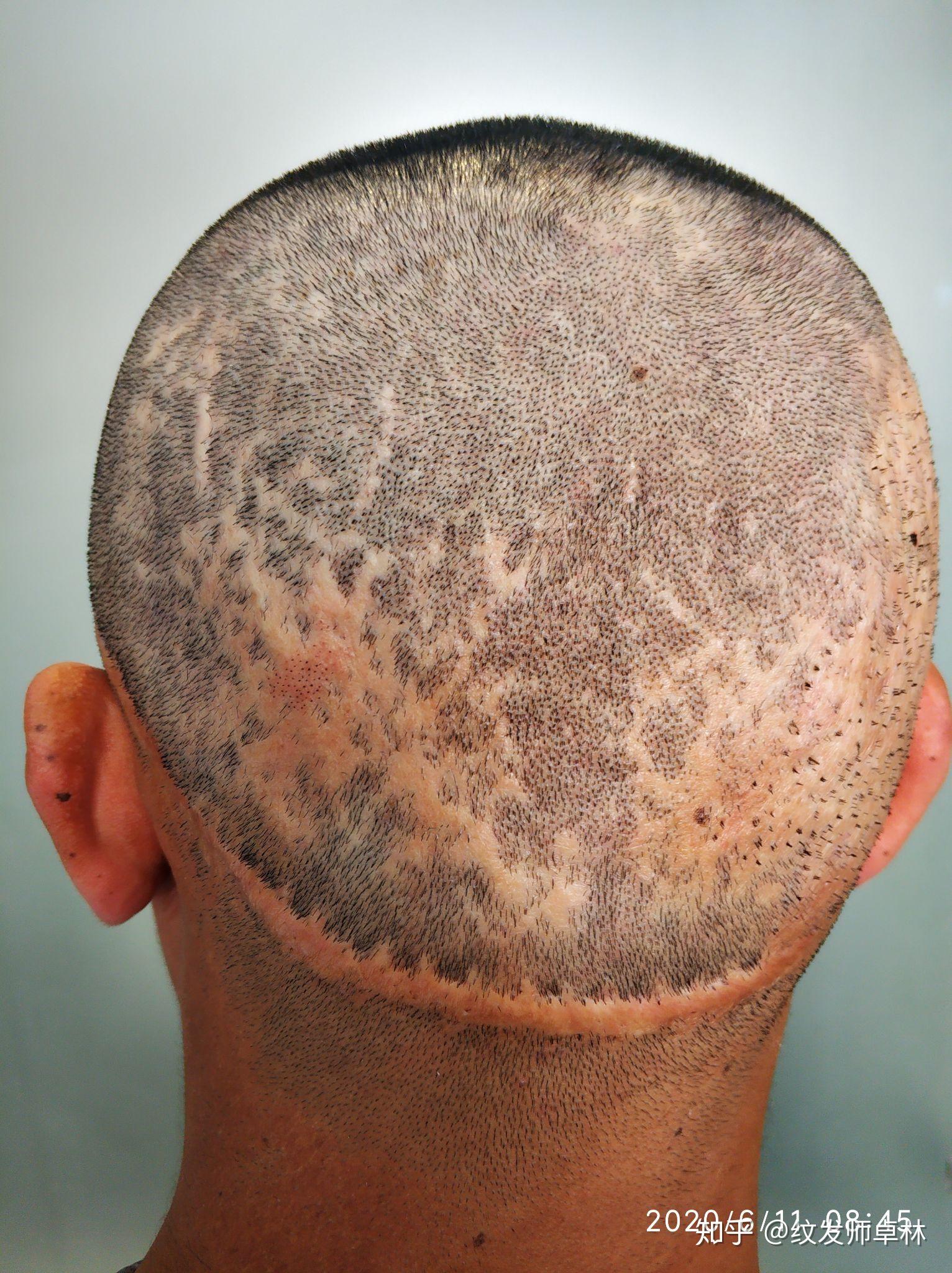 头皮上有手术疤痕十几年来都束着头发要工作影响形象有没有办法祛疤