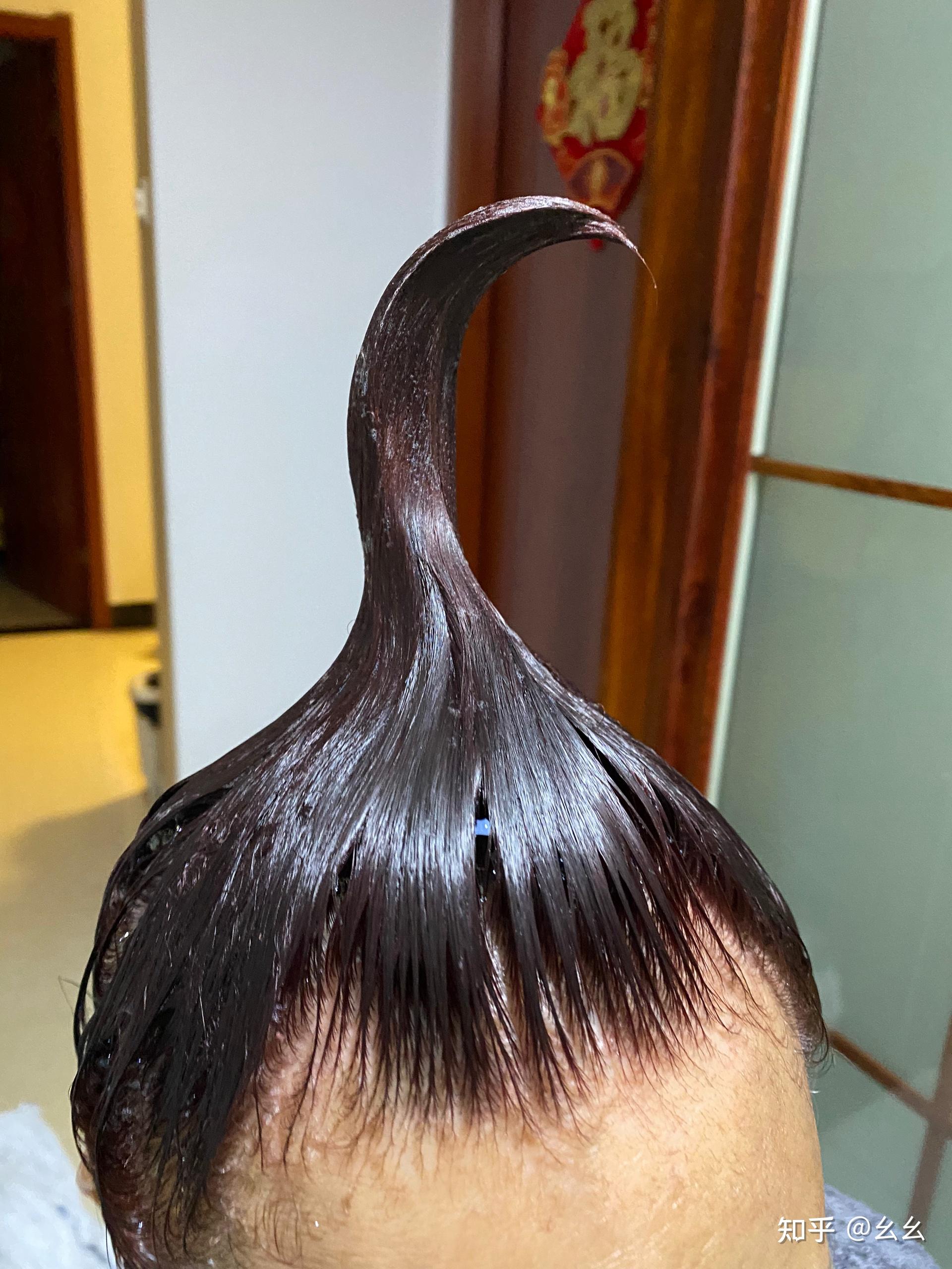 见过的最大头皮屑多大