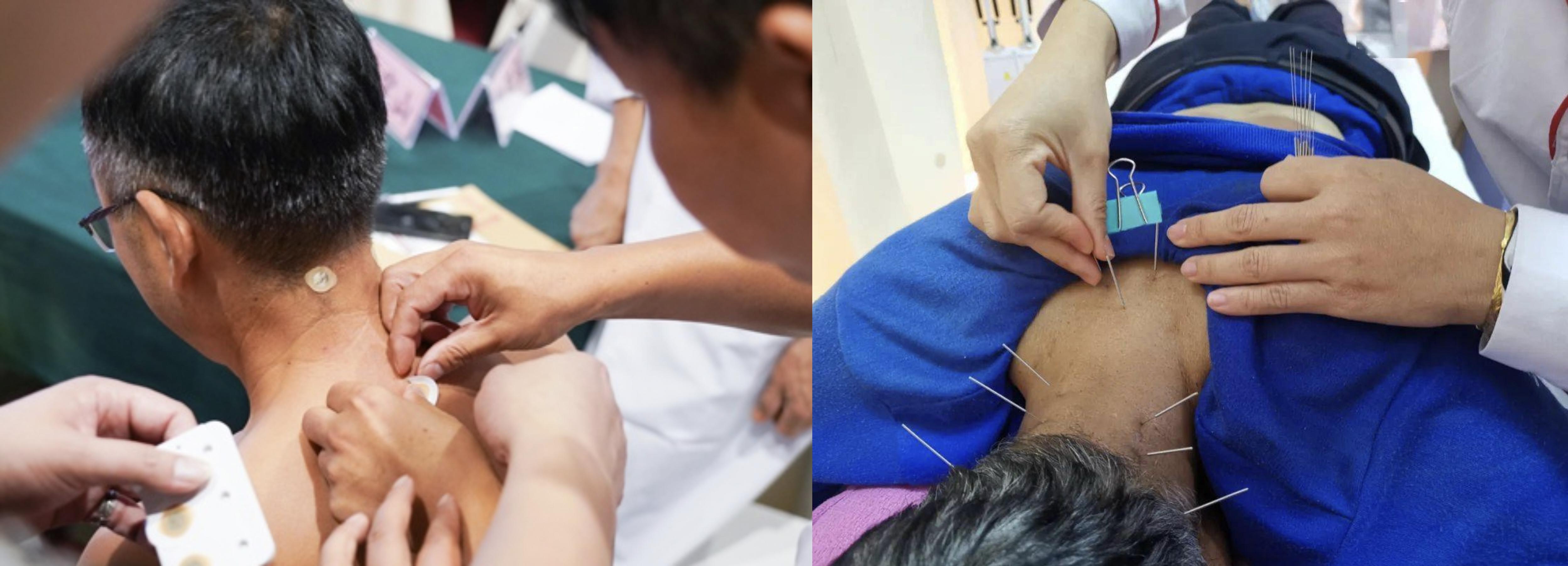 揿针可以代替针灸吗？揿针和针灸的区别是什么？ - 知乎