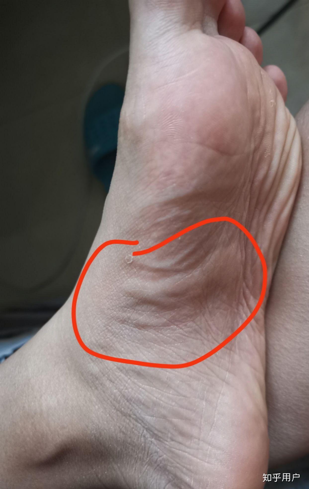 脚心被蚊子咬了是一种什么体验?