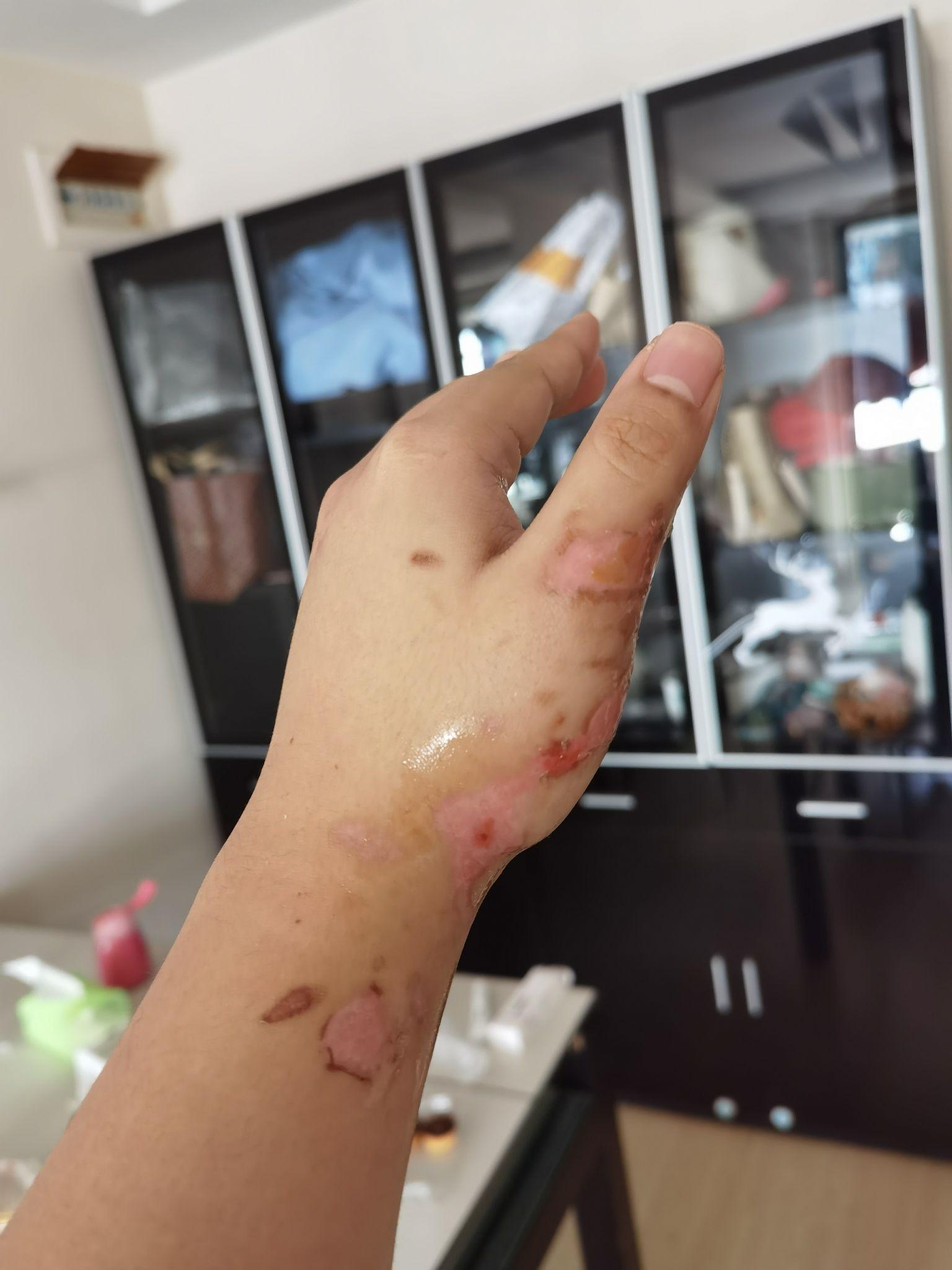 记录一下手被油烫伤的经过吧