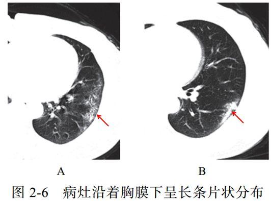 新冠肺炎ct早期征象与鉴别诊断 知乎 2748