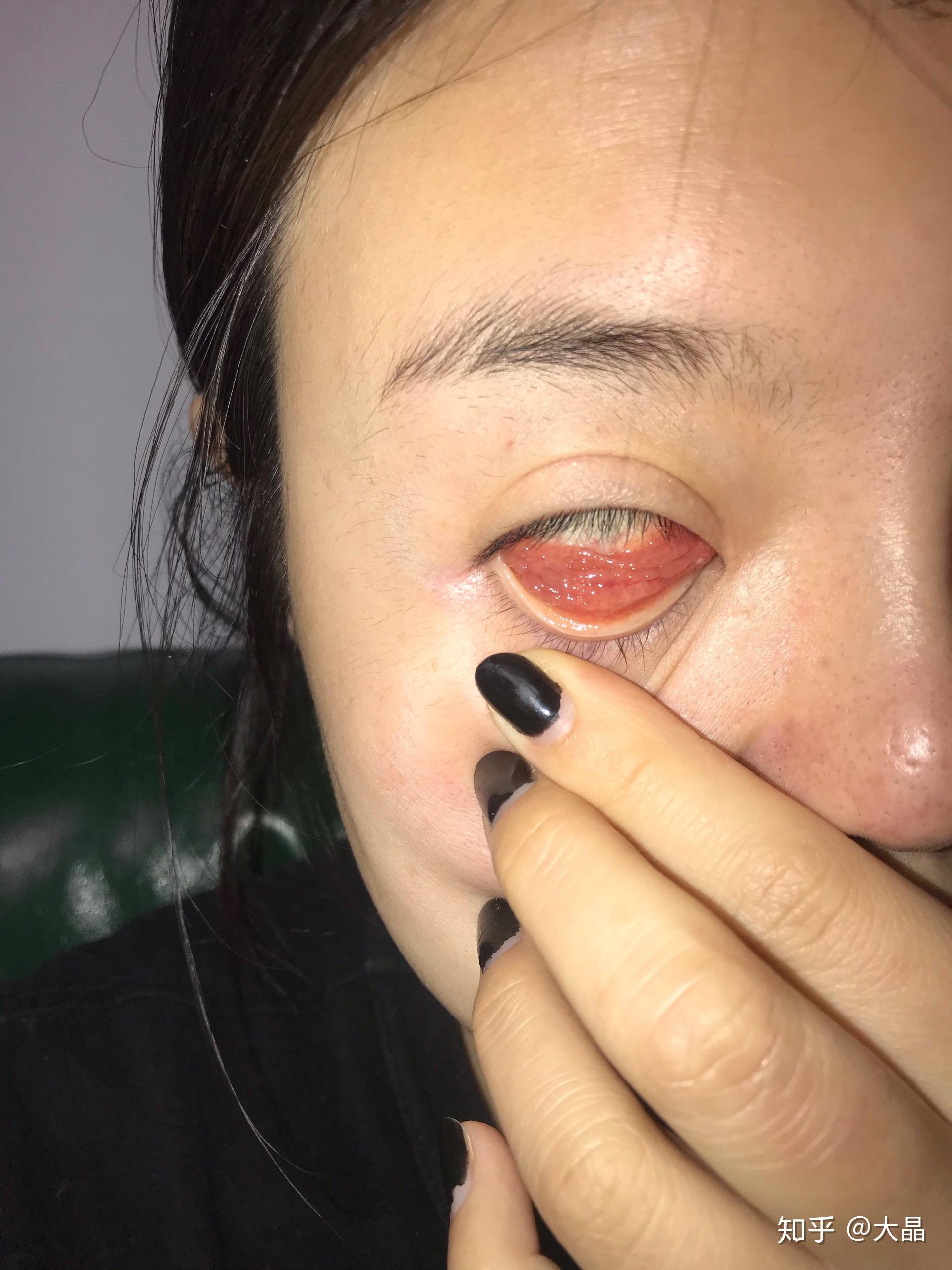 戴隐形导致上下眼皮有很多滤泡该怎么办