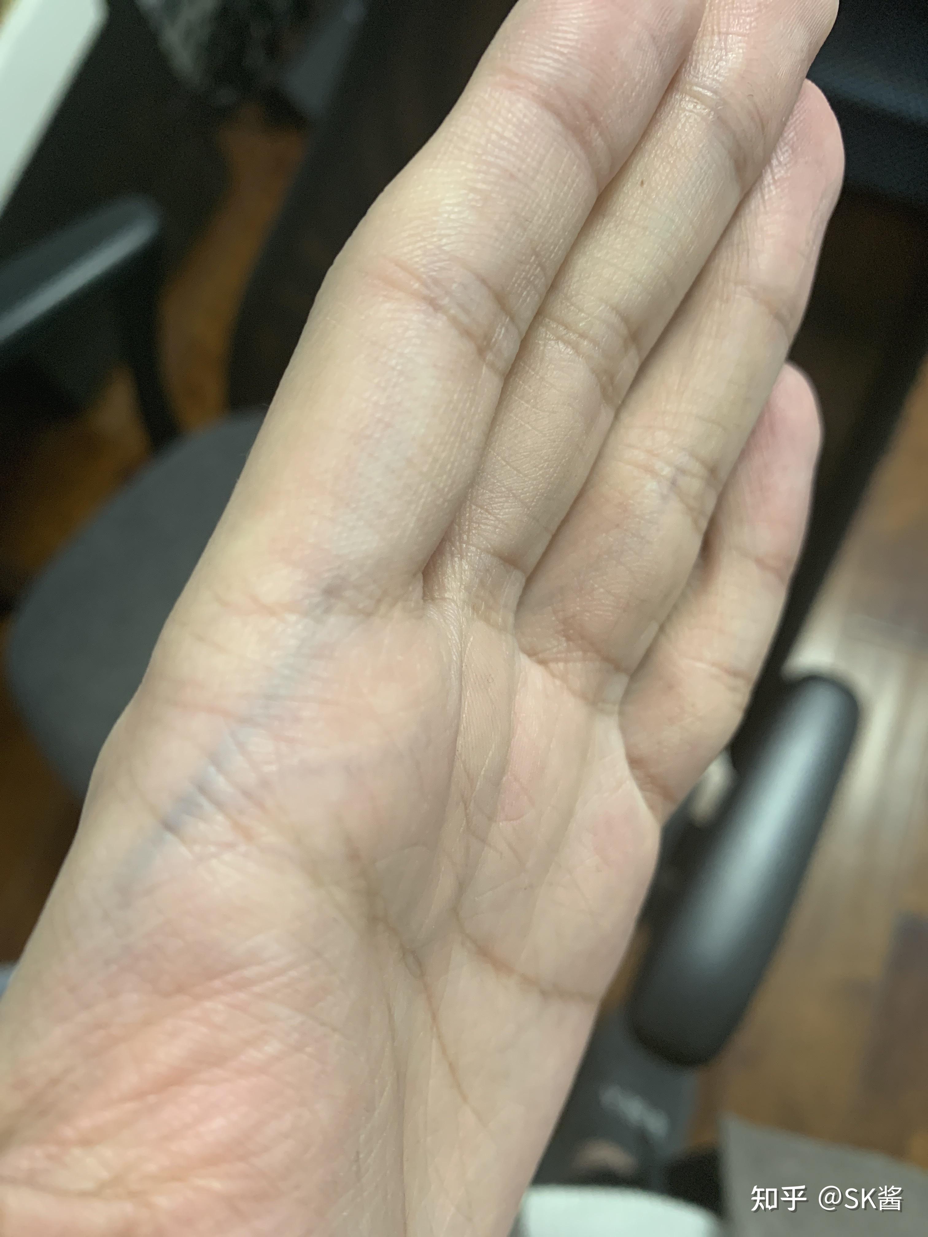 手腕上静脉颜色很明显,是身体有什么病症的原因吗? - 知乎