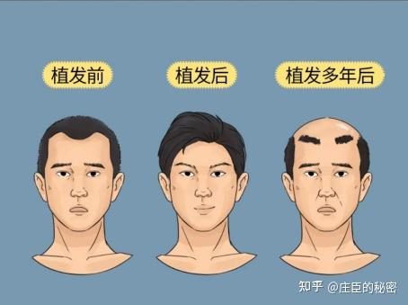 植发多久能排卵(植发多久后可以备孕)