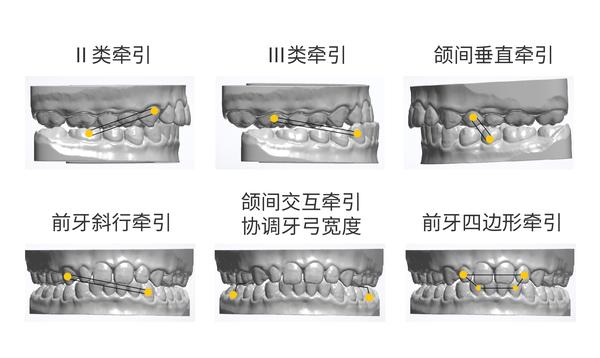 正畸课程合辑:隐形矫治中的牵引类型和矫治器的开口方向 - 知乎