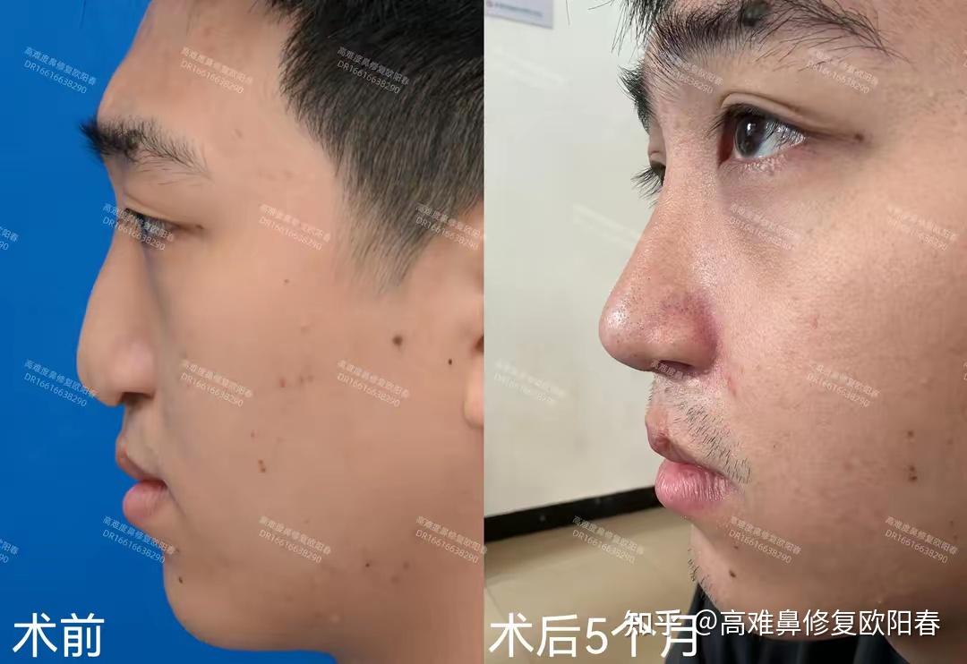 兔唇/唇裂鼻畸形都有哪些共同点? - 知乎