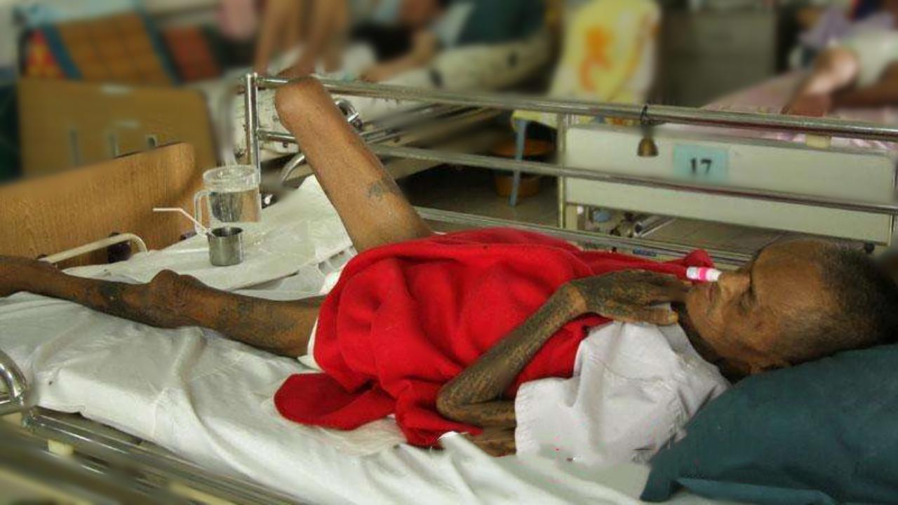 全球首个艾滋病人 v2-525cc7a2fa5dc8c8a944e895ed2ec110_1440w.jpg?source=172ae18b