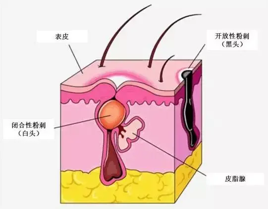 为毛囊漏斗部的上皮囊肿,是痤疮的早期阶段粉刺又分为黑头粉刺(开放性