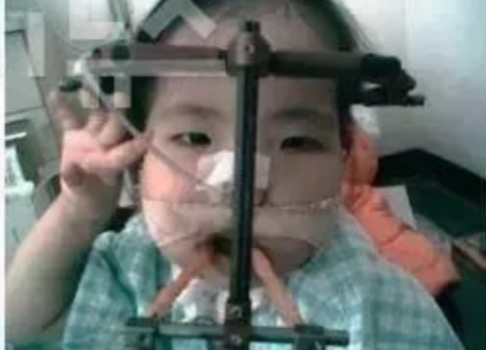 雅妍从小便要定期接受治疗