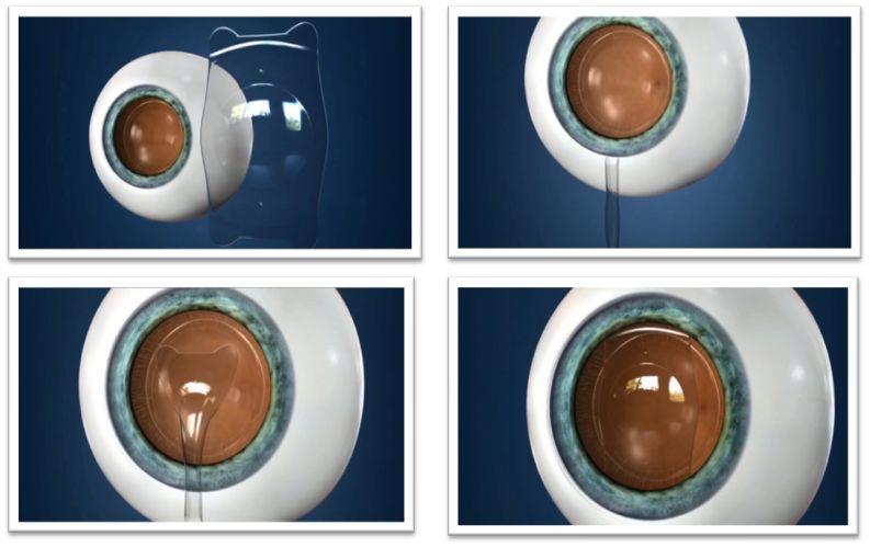 广州深圳做激光近视眼手术有风险吗