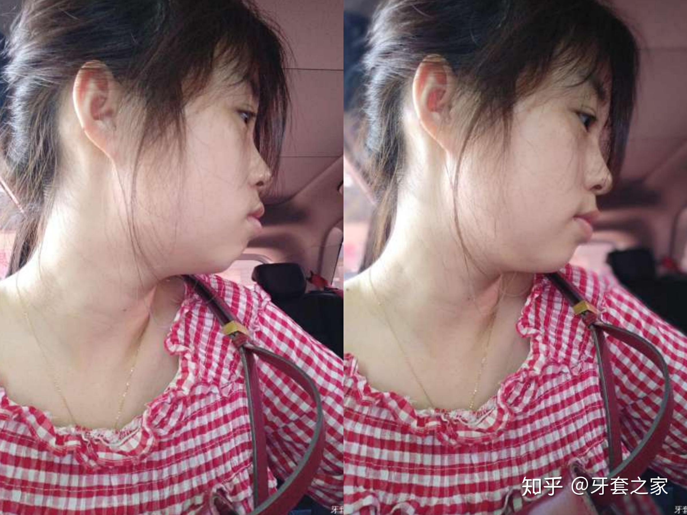 请问如何拯救凸嘴下巴后缩星人