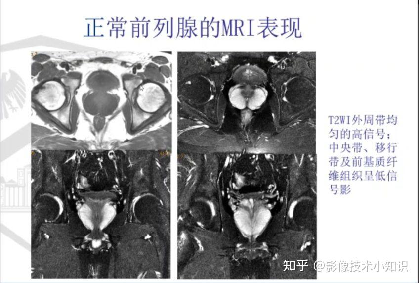 前列腺增生影像诊断 - 知乎