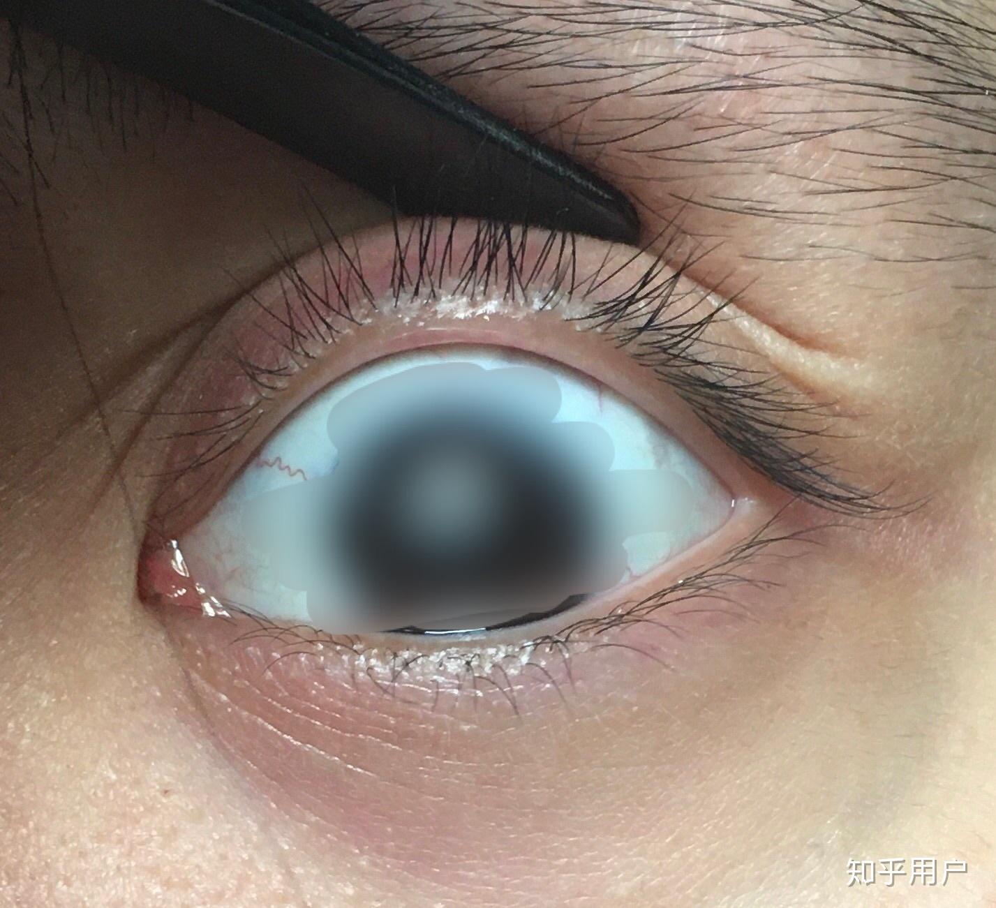 什么是双睫症身边有这样的朋友吗