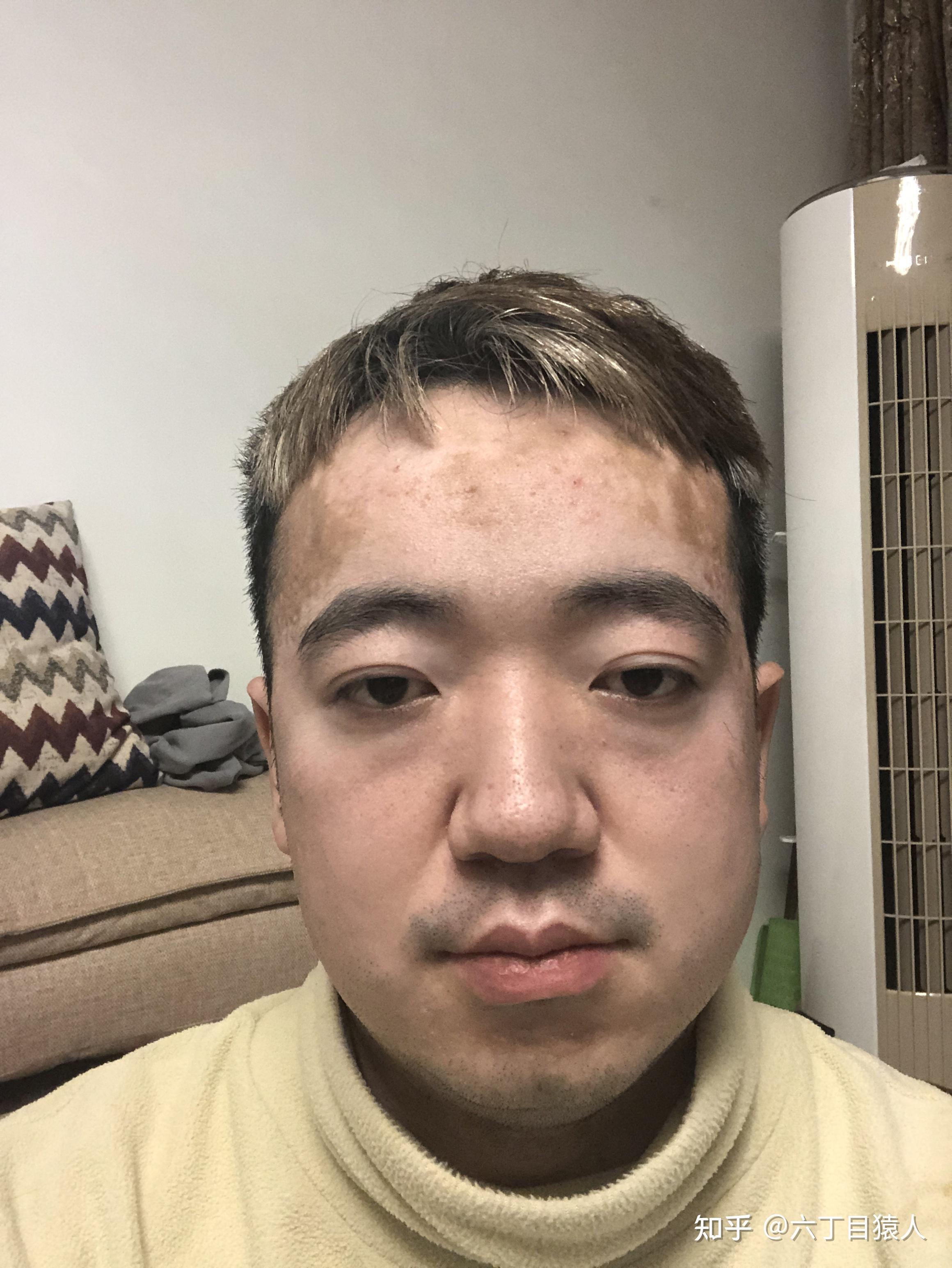 得了甲亢一个眼睛突出突能回去吗