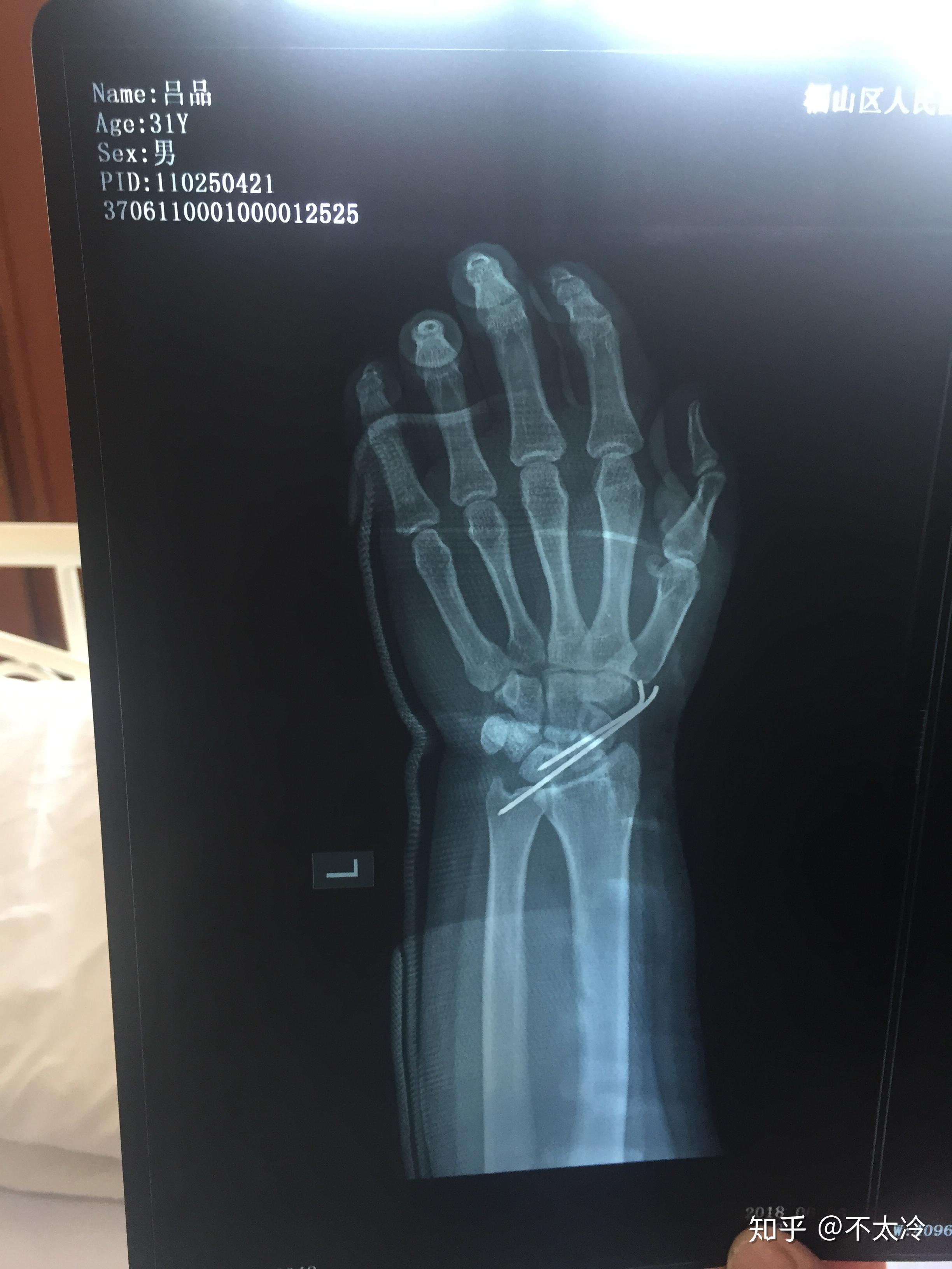 我左腕舟骨骨折,做手术穿了钢钉,有木有医学达人告诉我我可以喝酒吗?