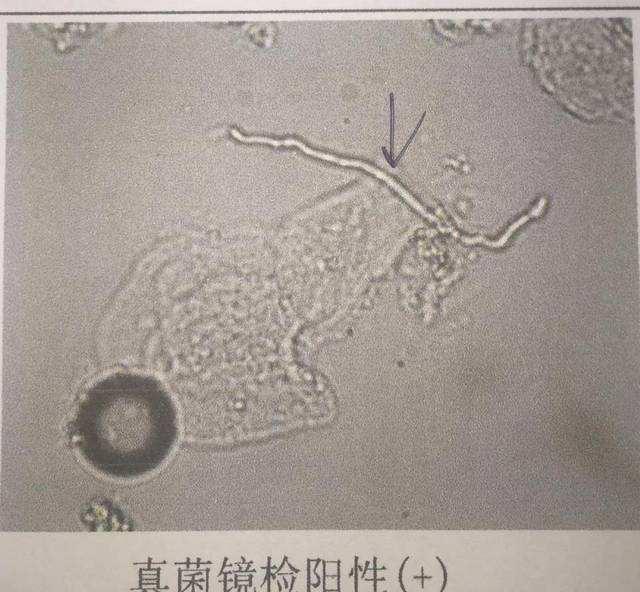 灰指甲与甲银屑病辨识 | 店长天龙科普