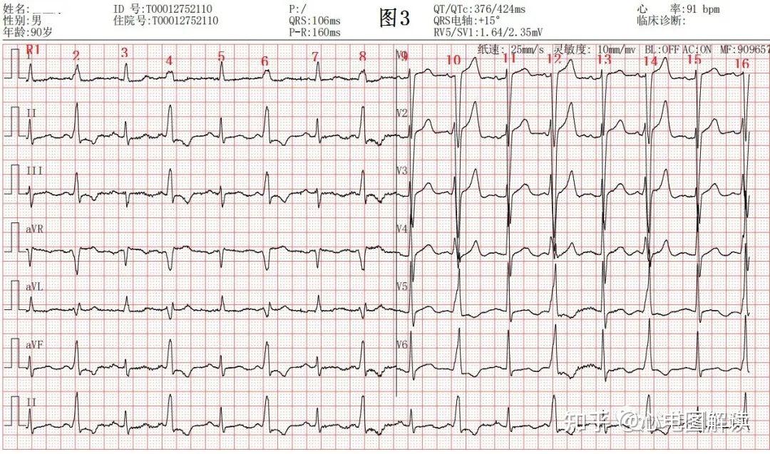 心室预激波?室性早搏二联律?