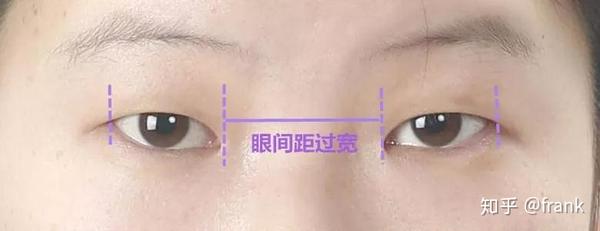 常眼距是一个眼睛的距离如果眼间距＞眼裂长就是眼间距过宽如下图所示：